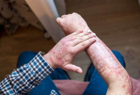 los síntomas de la psoriasis